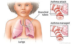 Asthma: ಇನ್‌ಹೇಲರ್‌ನಿಂದ ಆಚೆಗೆ - ಮಕ್ಕಳ ತೀವ್ರ ಅಸ್ತಮಾಕ್ಕೆ ತುರ್ತು ನಿಗಾ ತಂತ್ರಗಳು