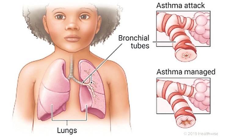 Asthma: ಇನ್‌ಹೇಲರ್‌ನಿಂದ ಆಚೆಗೆ - ಮಕ್ಕಳ ತೀವ್ರ ಅಸ್ತಮಾಕ್ಕೆ ತುರ್ತು ನಿಗಾ ತಂತ್ರಗಳು